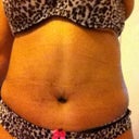 4wks post op