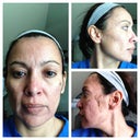 Day 6, Saturday, 24 November 2012.  not too bad, still peeling, and staying home for the night :-)