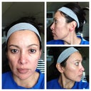 Sunday, morning of, day 7, 25 Nov 2012.  still peeling along hairline and under chin but much less than before.  religiously applying the moisturizer and spf 55.   majority of pics taken in direct sunlight from my window.  i felt that might give readers a more accurate picture of my progress.