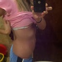 Stretch marks like tiger stripes all the way around to my back.