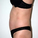 before surgery