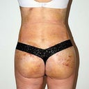 one week post op