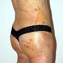 one week post op