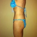 Day 25 Side View post op tummy tuck: very little swelling