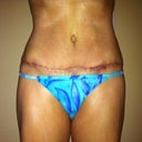 Day 25 post op tummy tuck Scar still healing