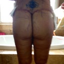 2 days post op buttock lift and fat transfer