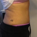 3.5 weeks post-op