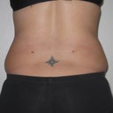 Back, 8 days post