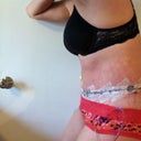 This is me 6 days after surgery facing left!  (I still can't stand up totally straight per my surgeons instructions)