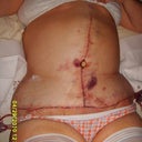A few days post op