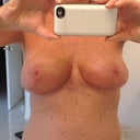 Three weeks to the day post-op.