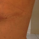 Left side-boob so you can see where incision ends and channel bruising from Lipo begins.