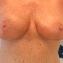 Close-up so you can see boxiness is sllooooowwwwwwwwly getting a little better on righty and lefty is still noticeably more swollen but developing a similar droop on outside lower quadrant.  Expect that is a result of swelling moving on.  Not noticeable in bra, so, meh...