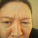 4 days after with my biggest frown