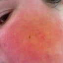 Day 3 post laser. You can see pixel marks, but no scars so far.  They were pretty deep on my cheeks.