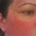 Day 3 post laser.
