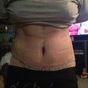 Post op day 4.  Looking great! Little swelling on my right side.