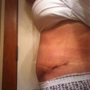 PO day 16. SWELL HELL - pretty swollen below bb.