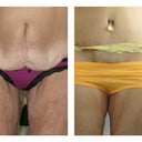 A bonus was the bit of lifting on the thigh skin-smoothed out a lot of the wrinkling.