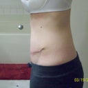 Day 18 Post Op