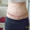 Day 18 Post Op
