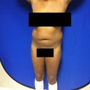 PreOp