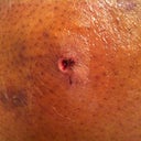 Drain hole ... I didn't drain right so they took it out on day 4. I did get a seroma but they drained it and i was fine. RELIEF!