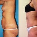 3 months post surgery