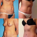 3 months post surgery