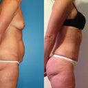 3 months post surgery