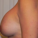 11 weeks one day post op 2