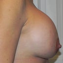 11 weeks one day post op 3