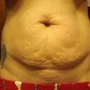 2 days before surgery