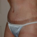 16 days post op, you can see the garment is tight!