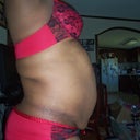 My right side 2 days pre-op.