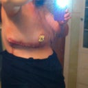 1 day post op side view.