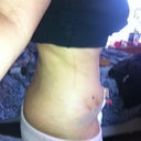 3 weeks post op