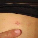 Tiny incision - look how well it has healed already! That's my pinky finger... ignore the chipped polish. I haven't changed it since before the operation!