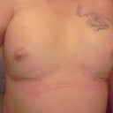 day two post op
