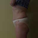 3 month After Side
