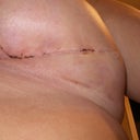 2 wk post op - scars are fading