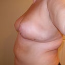 2 wk post op - less noticable
