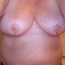 2 wk post op - but......they continue to be shaped like diamonds....
