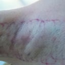Photo of underarm one day after second Miradry treatment