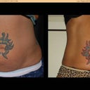 I finally have before/after pics for you!  This is within about 6 months & 3 totally pain-free treatments. .