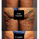 4 Weeks Post-Cellulaze.