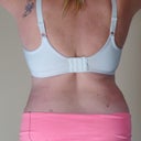 13 days POST OP