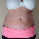 13 Day POST OP