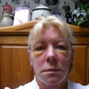 after surgery- one week.