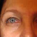 Before eye area wrinkles
